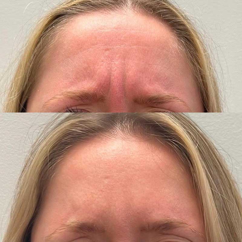 Before and after neurotoxin glabellar frown lines treatment