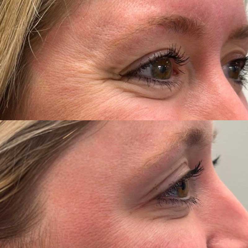 Before and after physician-led aesthetic treatment Rayhana Esthetics Pittsburgh