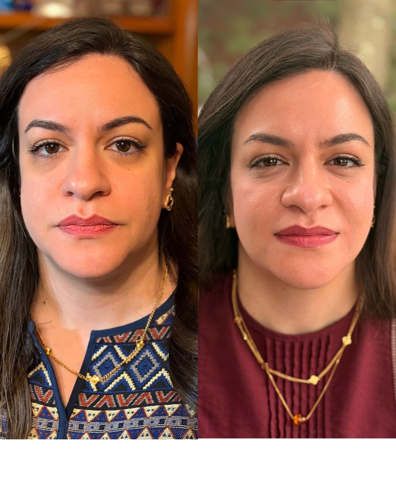 Mrs. R — before and after, frontal view