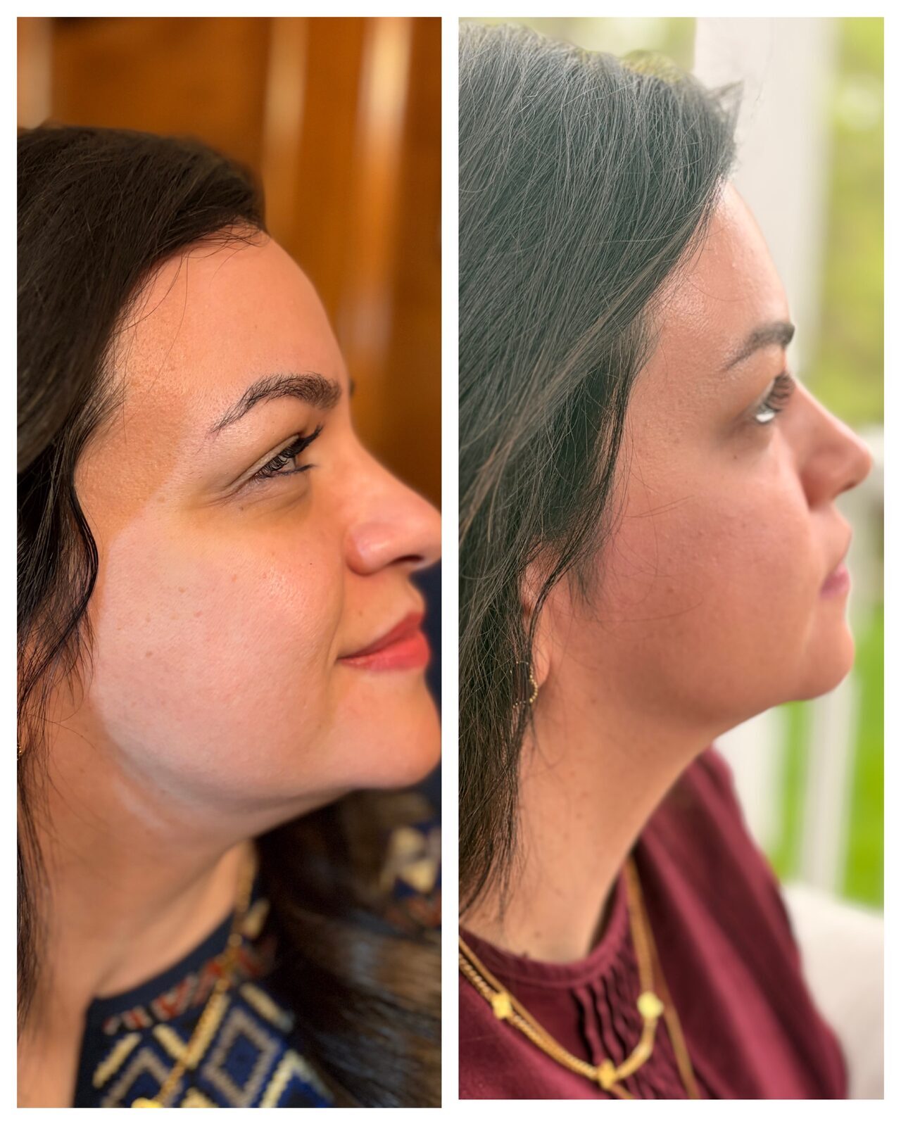 Mrs. R — before and after, side profile