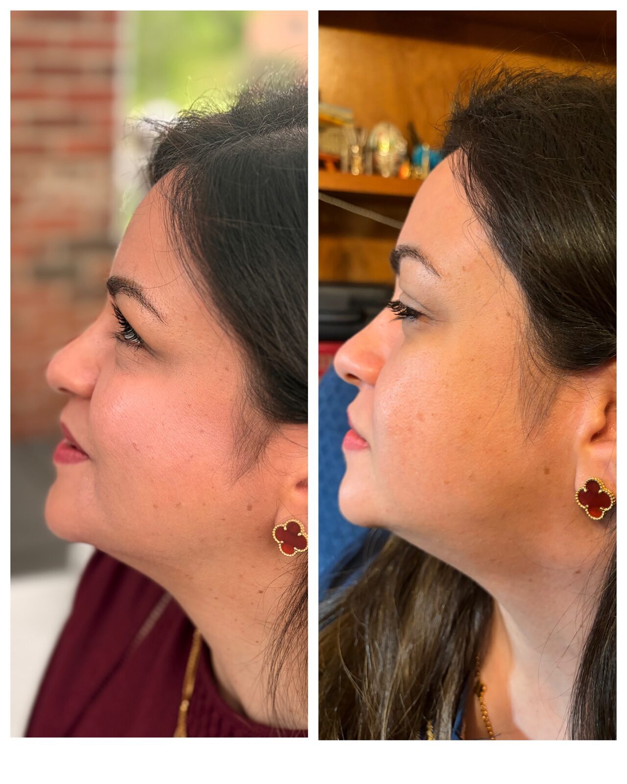 Mrs. R — before and after, three-quarter profile